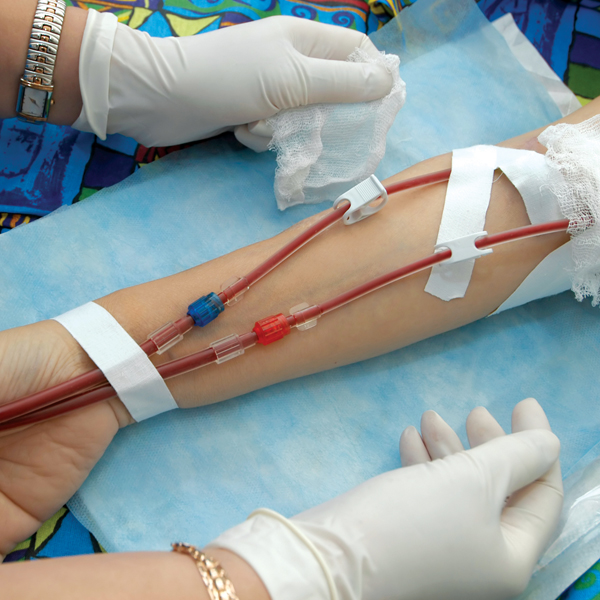 dialysis access