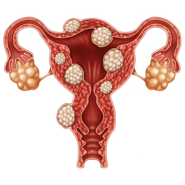 uterine fibroids
