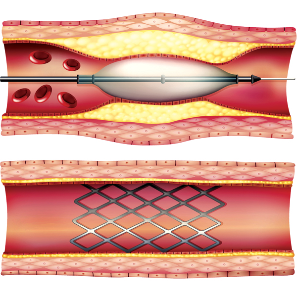 vascular disease